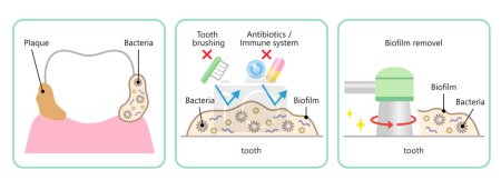 ilustración de eliminación de biopelículas dentales. salud dental y concepto de cuidado bucal
