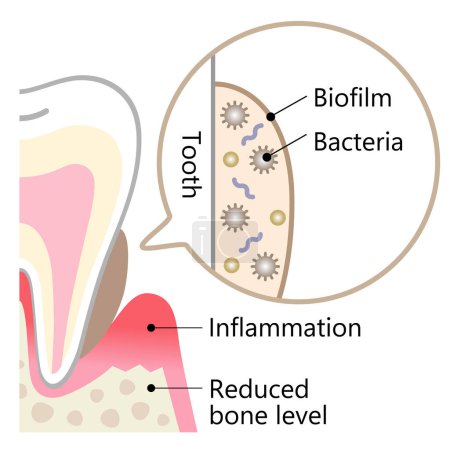 Biofilm dental en ilustración dental. concepto de higiene dental y cuidado bucal