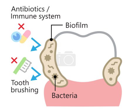 Illustration zur Entfernung des zahnärztlichen Biofilms. Bakterien und Plaque-Attachment am Zahn. Zahngesundheit und Mundpflege