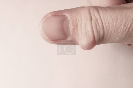 Ganglion cyst, synovial cyst disease, on the thumb of a womans hand. Selective focus.
