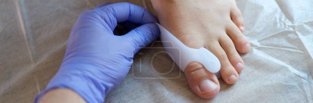 Téléchargez les photos : Top view of doctor orthopedist applying brace for hallux valgus. Deformity of joints of foot and healthcare concept - en image libre de droit
