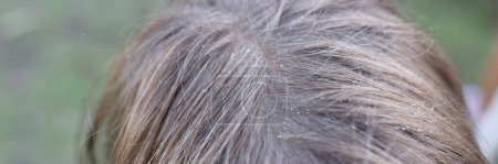 Photo for Top view of drops of water or dandruff on childs hair. Kid enjoys water flowing over head. Leisure time and entertainment concept. Hygiene idea - Royalty Free Image