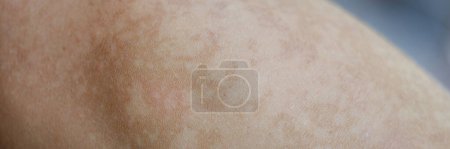 Téléchargez les photos : Close-up part of the body uneven pigmentation of the skin, vitiligo. Dermatology, medicine, genetic disease - en image libre de droit