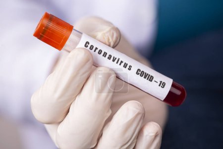 Téléchargez les photos : 2019-nCoV Coronavirus. Échantillon de sang positif dans la main des médecins. Syndrome respiratoire. Éclosion du coronavirus - en image libre de droit