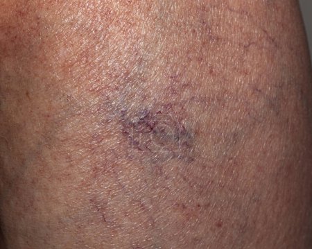 Photo for Close up of varicose veins on the leg of an elderly caucasian woman - Royalty Free Image