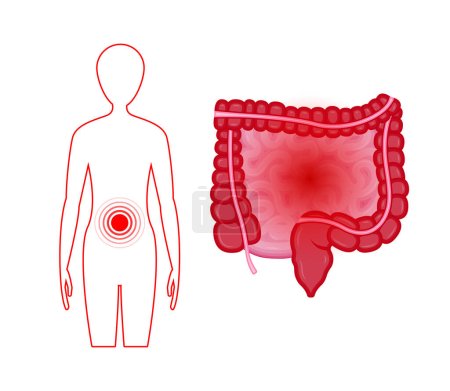 Illustration for Ulcerative Colitis. Inflammatory bowel disease. Ulcer and inflammation of the digestive tract, abdominal pain. Human internal organ, anatomy, medicine concept, healthcare - Royalty Free Image
