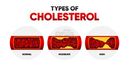 Illustration for Types Cholesterol. LDL and HDl level. Arteriosclerosis, infarct, ischemia, thrombosis disease. Cholesterol in human blood vessels. Vector illustration - Royalty Free Image