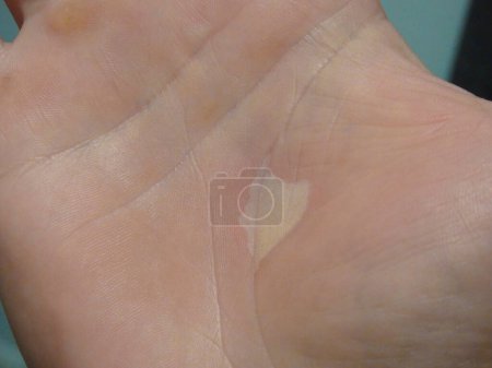 Torn callus of the hand close-up. Rough skin of male hand. Man showing his hand with callus