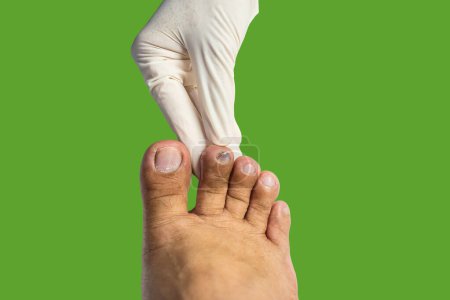 Téléchargez les photos : Formation d'hématome sur l'ongle de l'orteil causée par un objet dur. - en image libre de droit