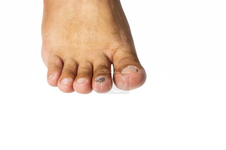 Téléchargez les photos : Formation d'hématome sur l'ongle de l'orteil causée par un objet dur. - en image libre de droit