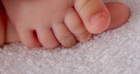 Photo for A baby, pus, a nail grew into a finger. Selective focus. - Royalty Free Image