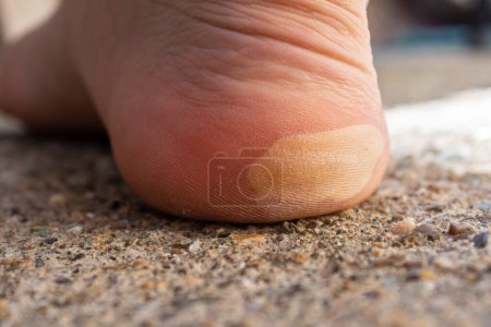 Foto de Ampollas en la piel del pie. Problemas de piel. - Imagen libre de derechos
