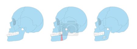 Ilustración de Cirugía ortognática vector ilustración sobremorder dientes dentales - Imagen libre de derechos