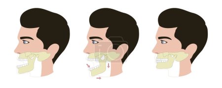 dislocado mandíbula vector ilustración primeros auxilios