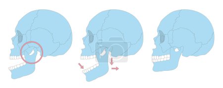 Illustration for Dislocation skull vector illustration - Royalty Free Image