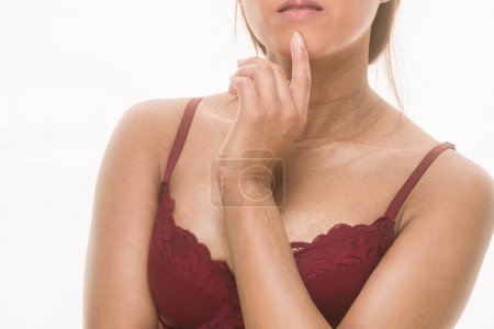 Photo for Woman face isolated on white background. autoinmmune chronic dermatosis for cosmetic products. Body positive and body inclusivity authentic imperfect beauty - Royalty Free Image