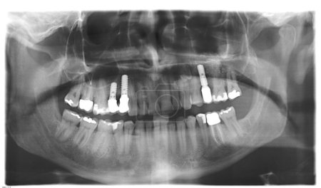 Foto de Imagen de rayos X con implantes dentales - Imagen libre de derechos