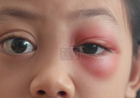 Téléchargez les photos : Gros plan d'une gamine asiatique aux yeux bruns infectée par un stye. Abcès des paupières, hordéole dans la santé médicale, la maladie et le concept de traitement - en image libre de droit