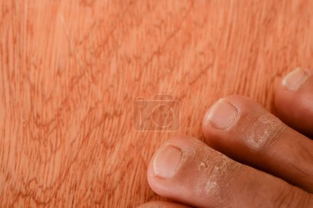 Athlete's foot, medically known as tinea pedis, fungal infection affecting the skin of the feet with symptoms such as itching, burning, and redness.