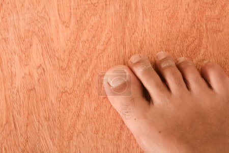 Fußpilz, der die Haut der Füße mit Symptomen wie Juckreiz, Brennen und Rötung befällt.
