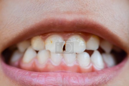 Foto de Una imagen ampliada captura las bocas de los niños con dientes desalineados, fracturados y odontología. - Imagen libre de derechos