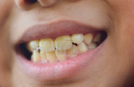 Téléchargez les photos : Un enfant montrant ses dents jaunies, soulignant l'importance des soins dentaires et des pratiques d'hygiène en dentisterie. - en image libre de droit