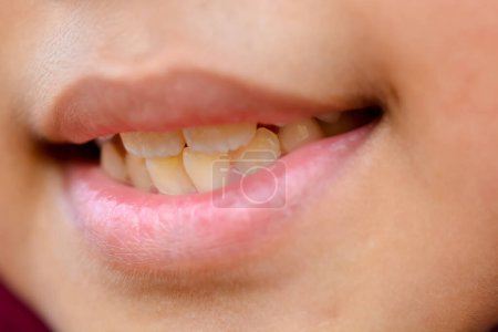 Téléchargez les photos : Un enfant montrant ses dents jaunies, soulignant l'importance des soins dentaires et des pratiques d'hygiène en dentisterie. - en image libre de droit