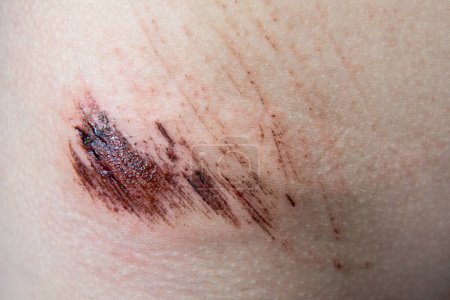 Téléchargez les photos : Gros plan d'une blessure sur la peau de l'enfant, douleur cutanée, patient - en image libre de droit