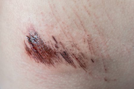 Téléchargez les photos : Gros plan d'une blessure sur la peau de l'enfant, douleur cutanée, patient - en image libre de droit