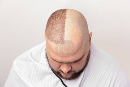 calvitie masculine avant et après le traitement. portrait d'un homme avec problème de calvitie lors d'une opération de greffe de cheveux. Chirurgie esthétique. le processus de transplantation de cheveux sur la tête.