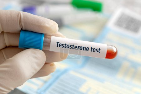Resultado de la prueba hormonal de testosterona con la muestra de sangre en el tubo de ensayo en la mano del médico en el laboratorio médico en un fondo de laboratorio azul.