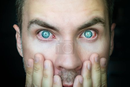 Téléchargez les photos : Rougeur des yeux de l'homme, un regard surpris sur la caméra. conjonctivite de la maladie oculaire. - en image libre de droit