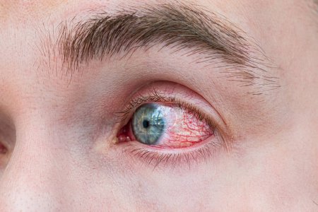 Téléchargez les photos : Homme aux yeux rouges, tir macro. Infection conjonctivite. Le concept de maladie oculaire, conjonctivite allergique hyperémie - en image libre de droit