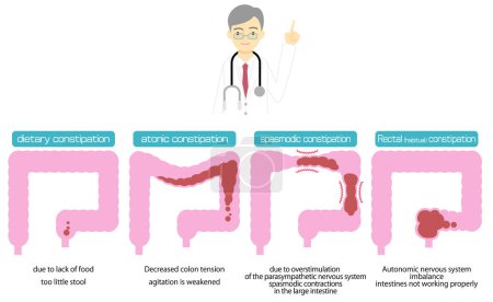Téléchargez les illustrations : Illustrated types of constipation by cause - en licence libre de droit