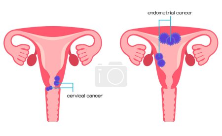 Illustration for Illustrated types of uterine cancer - Royalty Free Image