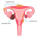 Illustrated types of gynecological diseases, endometriosis