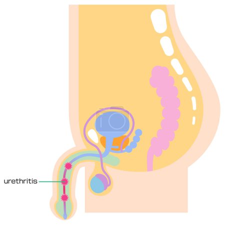 Ilustración de Illustrated internal organs with urethritis - Imagen libre de derechos