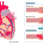 Illustrated illustration of heart disease