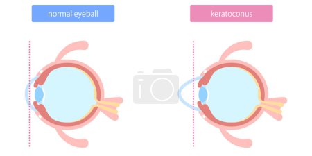 Illustration for Illustration of eyeball abnormality, keratoconus - Royalty Free Image