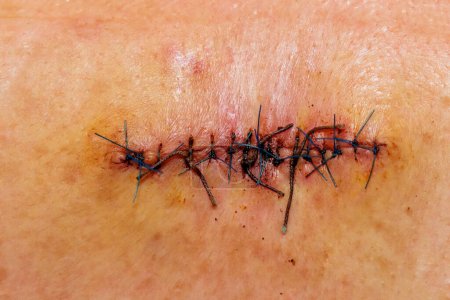 Téléchargez les photos : Double cicatrice suturée d'abcès chirurgical sur le dos - en image libre de droit