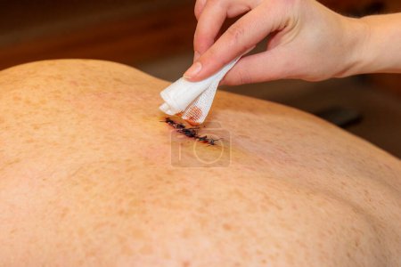 Photo for A hand cleans a double sutured scar from abscess surgery on a back with iodine and a swab - Royalty Free Image