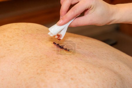 A hand cleans a double sutured scar from abscess surgery on a back with iodine and a swab