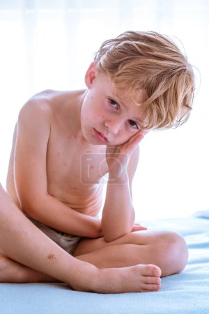 Photo for Shirtless barefoot boy with varicella blisters leaning on hand and looking at camera while sitting cross legged on bed in daytime - Royalty Free Image