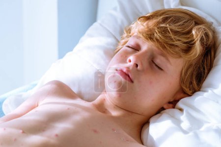 Téléchargez les photos : D'en haut garçon malade avec des ampoules de varicelle sur le torse nu couché sur un lit doux et dormant par une journée ensoleillée à la maison - en image libre de droit