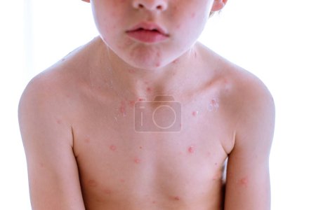 Photo for Crop kid with chickenpox blisters on naked torso and face against white background on sunny day at home - Royalty Free Image
