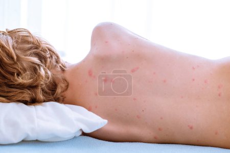 Foto de Niño rubio irreconocible con ampollas de varicela en la cama desnuda acostado y descansando en la cama en el dormitorio soleado en casa - Imagen libre de derechos