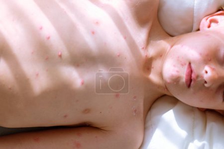 Photo for Top view of cop boy with chickenpox blisters on naked torso lying on bed in sunlit bedroom at home - Royalty Free Image
