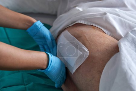 Téléchargez les photos : Mains de culture infirmière méconnaissable dans des gants application de plâtre chirurgical antibactérien sur la jambe du patient couché sur le lit à l'hôpital - en image libre de droit