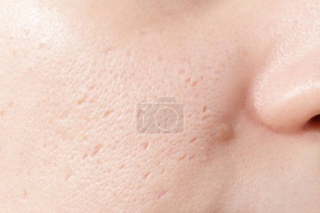 Gros plan du visage de la femme a des problèmes avec la peau sur son visage. Problèmes d'acné et cicatrice sur la peau féminine.