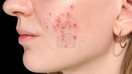 Photo for Skin healing period after erbium laser facial resurfacing. Young woman suffering from problem skin. Treatment of ice pick scars. Day 1. - Royalty Free Image